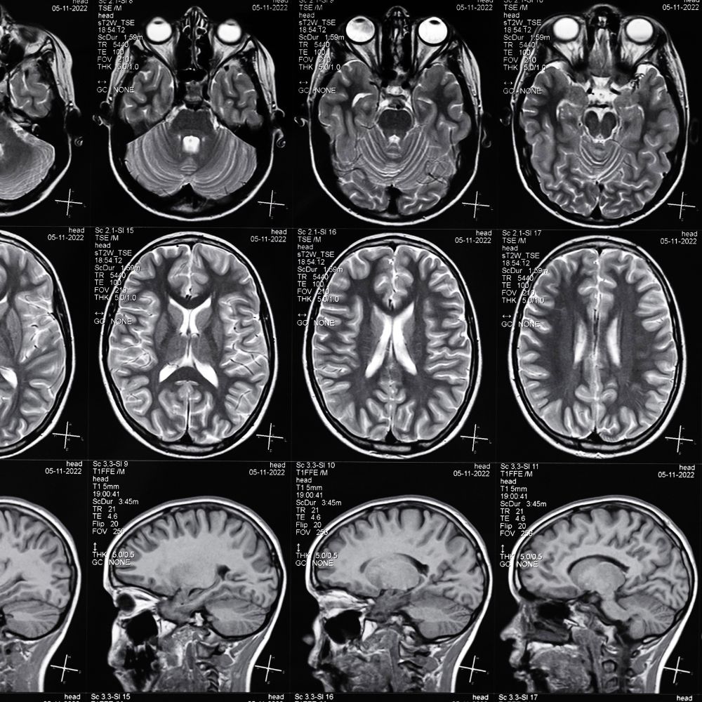 Brain Scan | Traumatic Brain Injury Lawyer